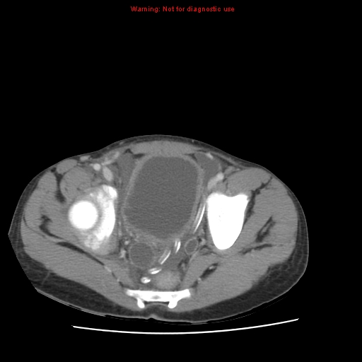 File:Appendicitis with phlegmon (Radiopaedia 9358-10046 A 63).jpg