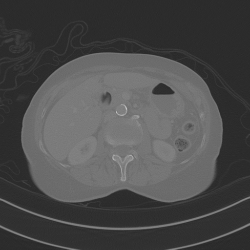 April fools' 2019- calcified peritoneal arachnoidosis (Radiopaedia 67273-76636 Axial bone window 13).png
