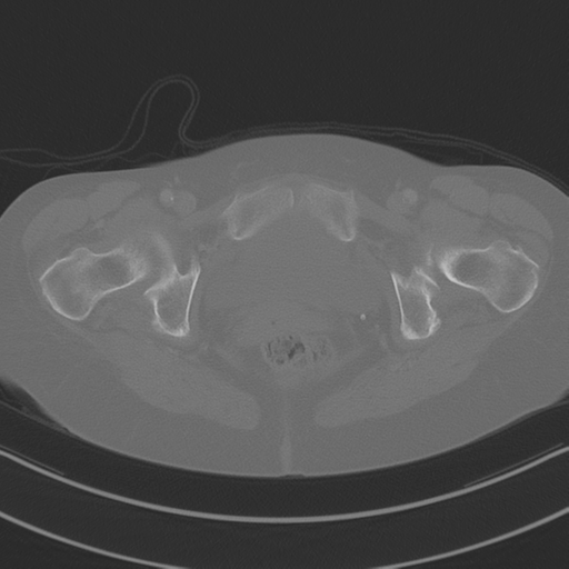 April fools' 2019- calcified peritoneal arachnoidosis (Radiopaedia 67273-76636 Axial bone window 58).png