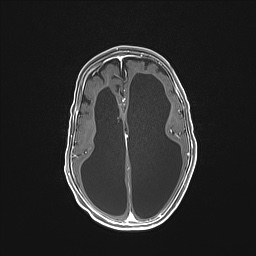 Aqueductal stenosis (Radiopaedia 73974-84802 Axial T1 C+ 96).jpg