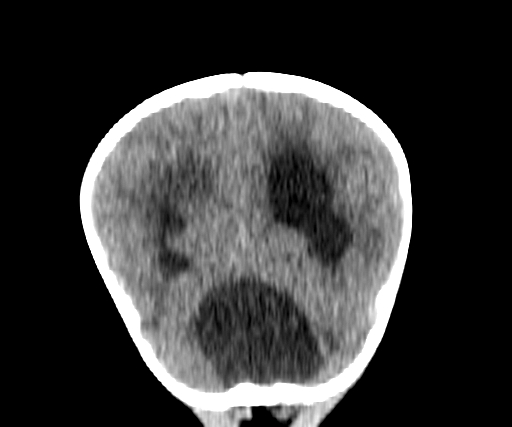 Arachnoid cyst-posterior fossa (Radiopaedia 88661-105370 Coronal non-contrast 60).jpg