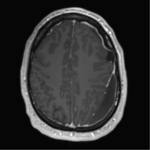 File:Arachnoid cyst with subdural hematoma (Radiopaedia 85892-101743 Axial T1 C+ 62).png