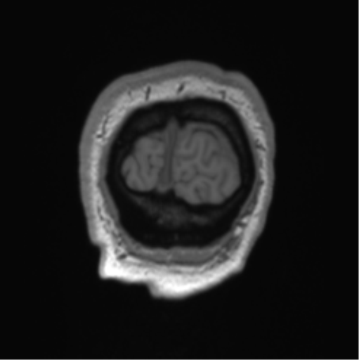 Arachnoid cyst with subdural hematoma (Radiopaedia 85892-101743 Coronal T1 3).png