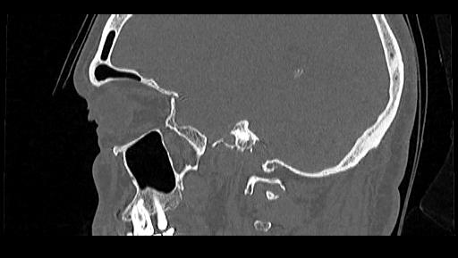 Arcuate foramen (Radiopaedia 89833-106944 Sagittal bone window 104).jpg