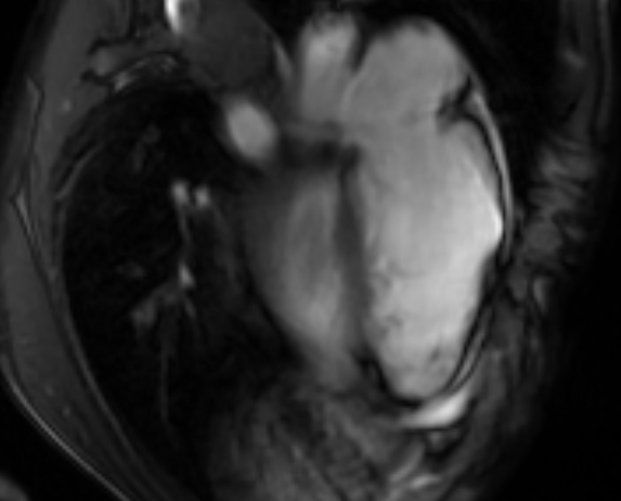 Arrhythmogenic right ventricular cardiomyopathy (Radiopaedia 69564-79464 4ch cine 110).jpg