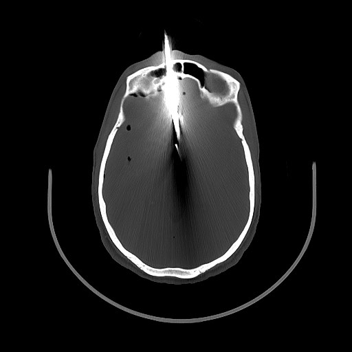 File:Arrow injury to the brain (Radiopaedia 72101-82607 Axial bone window 70).jpg