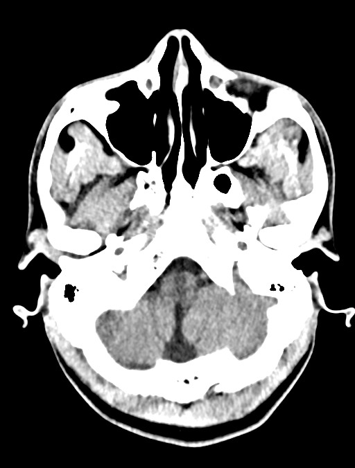 Arrow injury to the head (Radiopaedia 75266-86388 Axial non-contrast 7).jpg