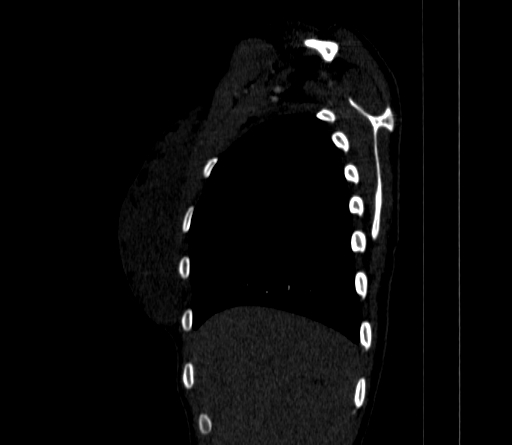 File:Arteria lusoria (Radiopaedia 88528-105192 C 22).jpg