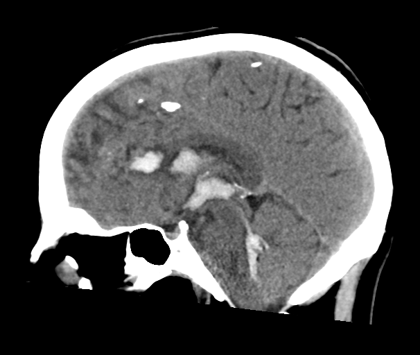 File:Arteriovenous malformation (cerebral) (Radiopaedia 40070-42579 B 17).png