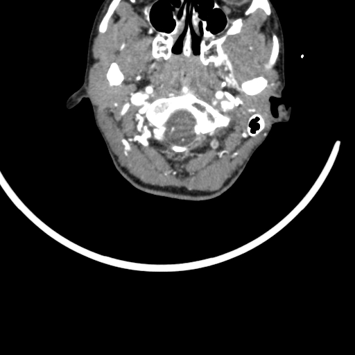 Arteriovenous malformation of the neck (Radiopaedia 53935-60062 A 64).jpg