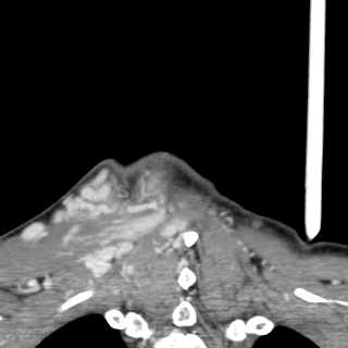 Arteriovenous malformation of the neck (Radiopaedia 53935-60062 D 63).jpg