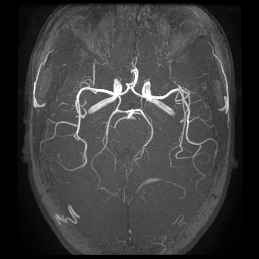 Artery of Percheron infarction (Radiopaedia 27975-28230 3D TOF 1).jpg