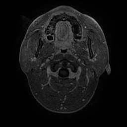 Artery of Percheron infarction (Radiopaedia 27975-28230 Axial T1 C+ fat sat 3).jpg