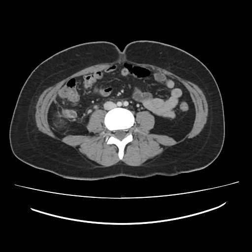 File:Ascending retrocecal appendicitis with liver abscesses (Radiopaedia 60066-67615 B 54).jpg
