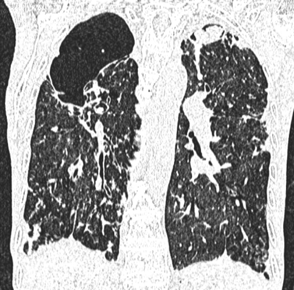 Aspergilloma- with Monod sign (Radiopaedia 44737-48532 Coronal lung window 301).jpg
