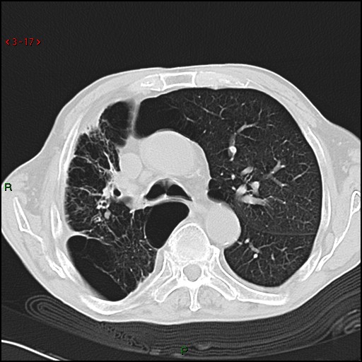 File:Aspergilloma (Radiopaedia 14842-14787 Axial lung window 17).jpg