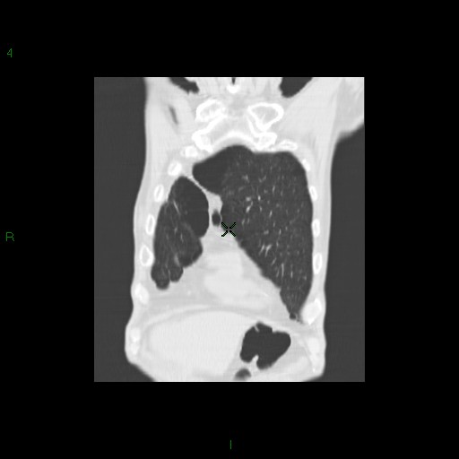 File:Aspergilloma (Radiopaedia 14842-14787 Coronal lung window 6).jpg