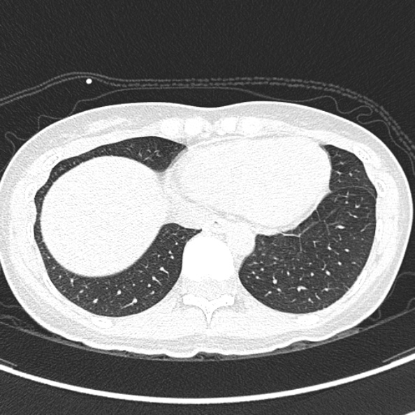 Aspergilloma (Radiopaedia 26223-26347 Axial lung window 60).jpg