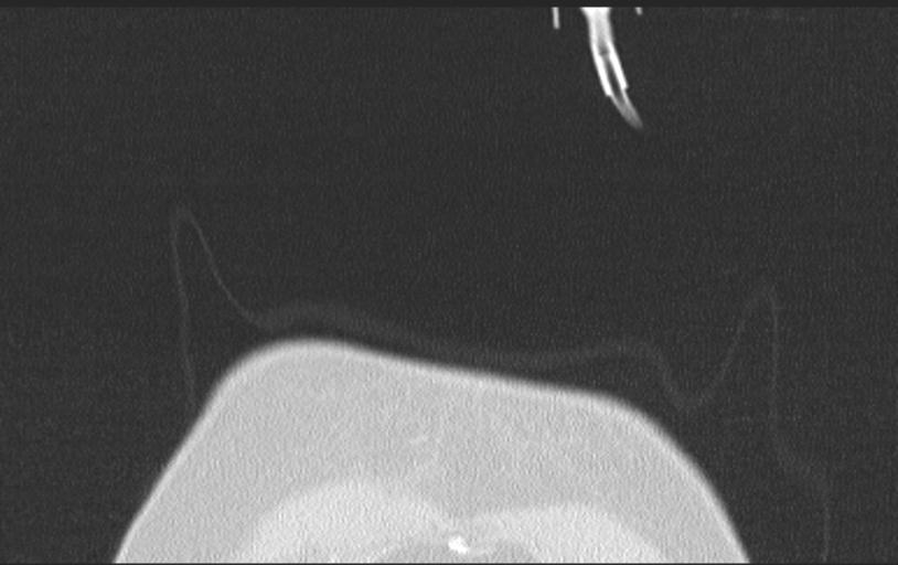 Aspirated tooth (Radiopaedia 28584-28844 Axial lung window 12).jpg