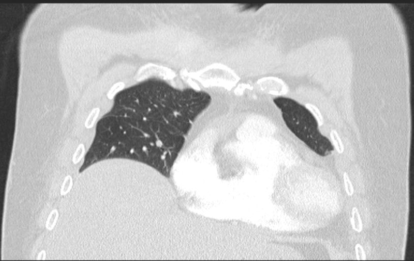 Aspirated tooth (Radiopaedia 28584-28844 Axial lung window 37).jpg