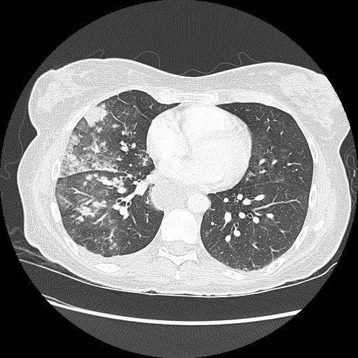 Aspiration pneumonia secondary to laparoscopic banding (Radiopaedia 18345-18183 lung window 67).jpg
