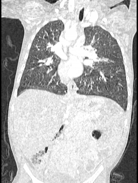 Asplenia syndrome (Radiopaedia 73083-83792 Coronal lung window 74).jpg