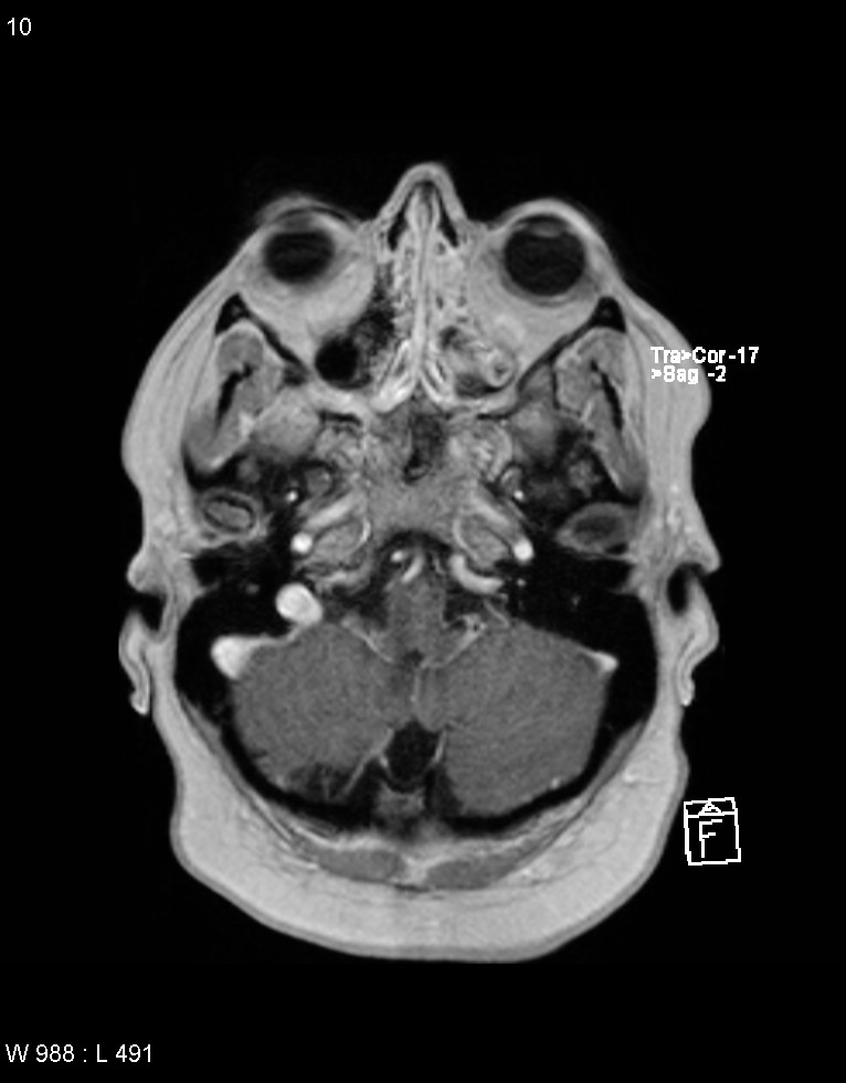 Astroblastoma (Radiopaedia 39792-42217 Axial T1 C+ 9).jpg
