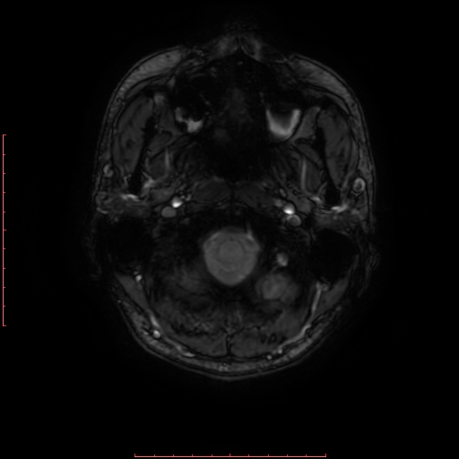 Astrocytoma NOS - cystic (Radiopaedia 59089-66384 Axial SWI 2).jpg