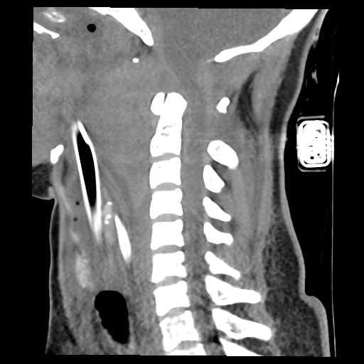 File:Atlanto-occipital dislocation (Radiopaedia 44648-48412 A 15).jpg