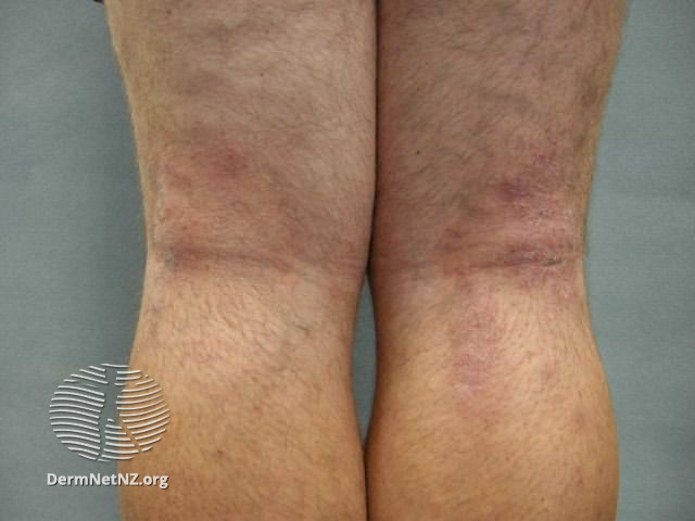 File:Atopic dermatitis (DermNet NZ dermatitis-flexural-eczema06).jpg