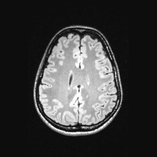 Atretic encephalocoele with inferior vermis hypoplasia (Radiopaedia 30443-31108 Axial 108).jpg