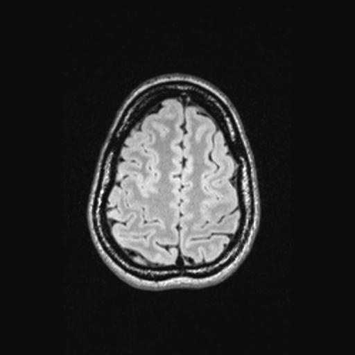 Atretic encephalocoele with inferior vermis hypoplasia (Radiopaedia 30443-31108 Axial 129).jpg