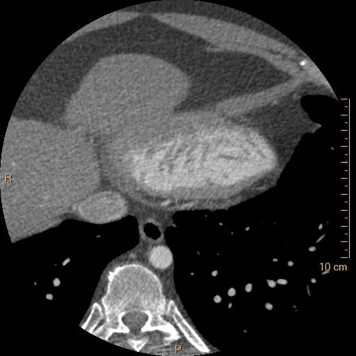 Atrial septal defect (upper sinus venosus type) with partial anomalous pulmonary venous return into superior vena cava (Radiopaedia 73228-83961 A 239).jpg