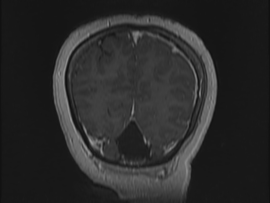Atypical meningioma (Radiopaedia 62985-71406 Coronal T1 C+ 111).jpg