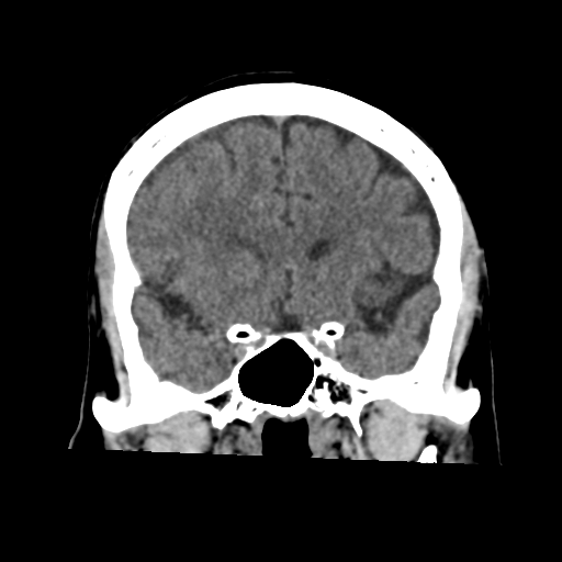Atypical meningioma (WHO grade II) with osseous invasion (Radiopaedia 53654-59715 Coronal non-contrast 25).png