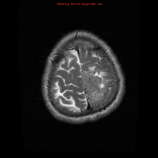 File:Atypical meningioma - grade II (Radiopaedia 13303-13305 Axial T2 20).jpg