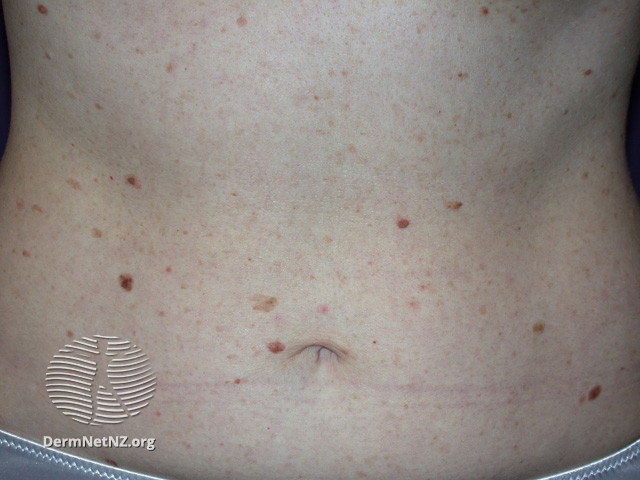 File:Atypical naevi (DermNet NZ lesions-atypical-naevi-581).jpg