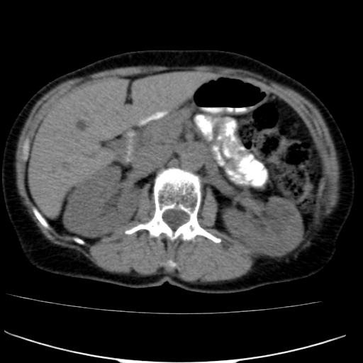 File:Atypical renal cyst (Radiopaedia 17536-17251 non-contrast 13).jpg