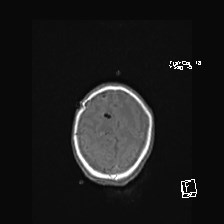 Atypical teratoid rhabdoid tumor (prenatal US and neonatal MRI) (Radiopaedia 59091-66388 Axial T1 49).jpg