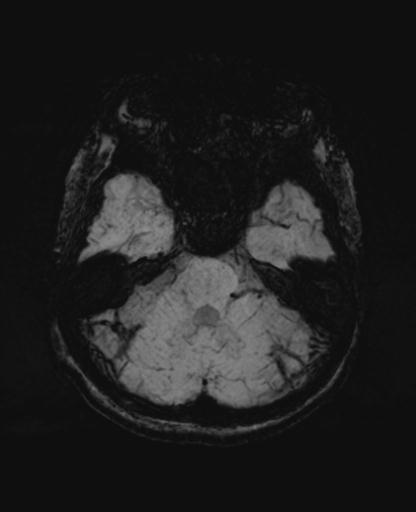 Autoimmune limbic encephalitis (Radiopaedia 30363-31005 SWI - mIP 20).jpg