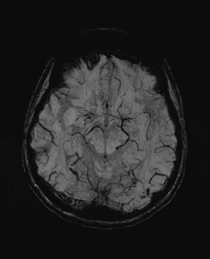 Autoimmune limbic encephalitis (Radiopaedia 30363-31005 SWI - mIP 29).jpg