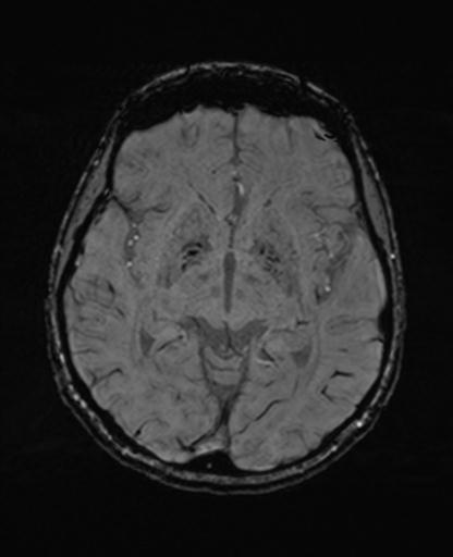 Autoimmune limbic encephalitis (Radiopaedia 30363-31005 SWI 36).jpg