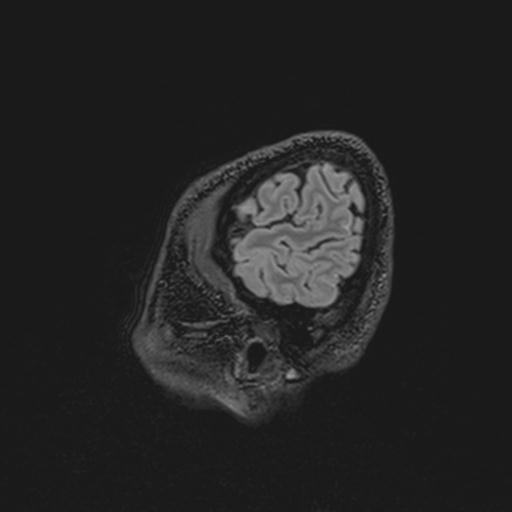 File:Autoimmune limbic encephalitis (Radiopaedia 30363-31005 Sagittal FLAIR 139).jpg