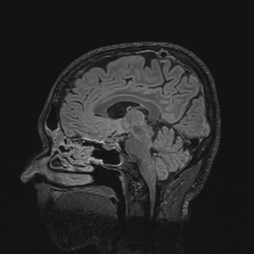 Autoimmune limbic encephalitis (Radiopaedia 30363-31005 Sagittal FLAIR 85).jpg