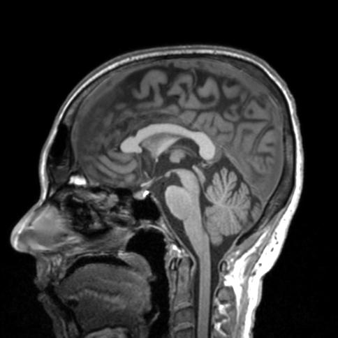 Autoimmune limbic encephalitis (Radiopaedia 30363-31005 T1 Axial 3mm 53).jpg