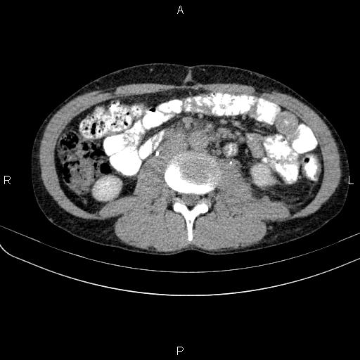 Autoimmune pancreatitis (Radiopaedia 84925-100431 Axial C+ delayed 44).jpg