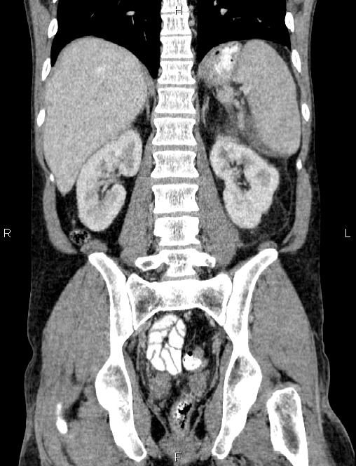 Autoimmune pancreatitis (Radiopaedia 84925-100431 D 42).jpg