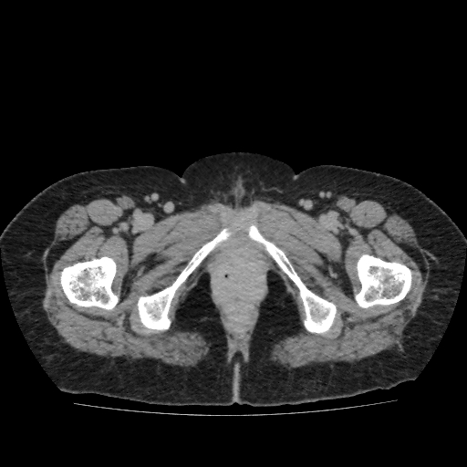 Autosomal dominant polycystic kidney disease (Radiopaedia 38189-40194 Axial C+ delayed 64).jpg