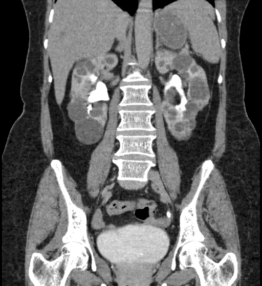 Autosomal dominant polycystic kidney disease (Radiopaedia 38189-40194 Coronal C+ delayed 55).jpg