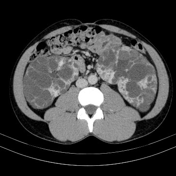 Autosomal dominant polycystic kidney disease (Radiopaedia 66349-75582 B 54).jpg
